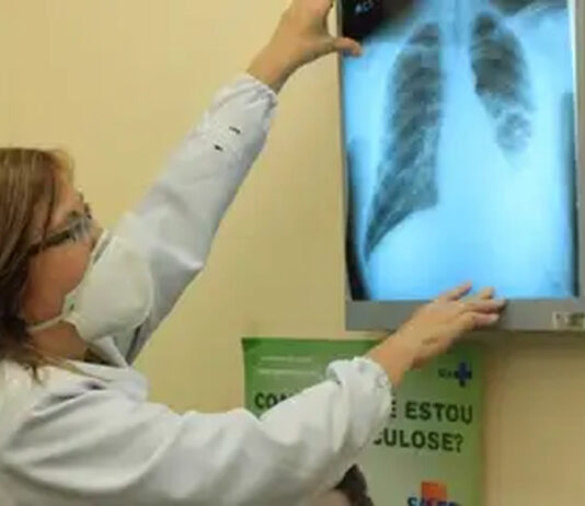 Tuberculose: Saúde faz campanha de busca ativa de novos casos tuberculose