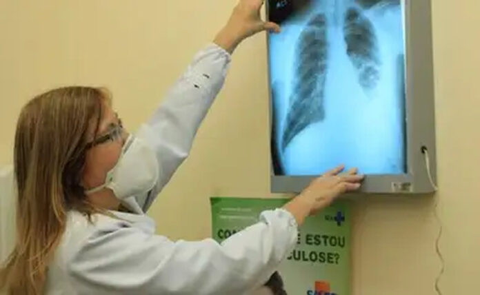 tuberculose tuberculose