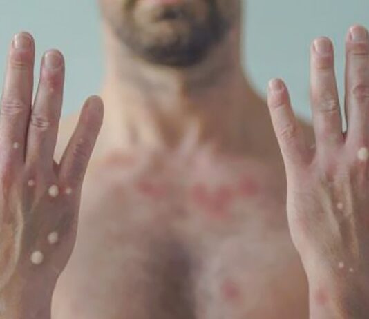 mpox