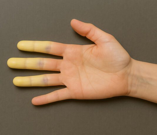 Síndrome de RAYNAUD surge no inverno e afeta mãos e pés SÍNDROME