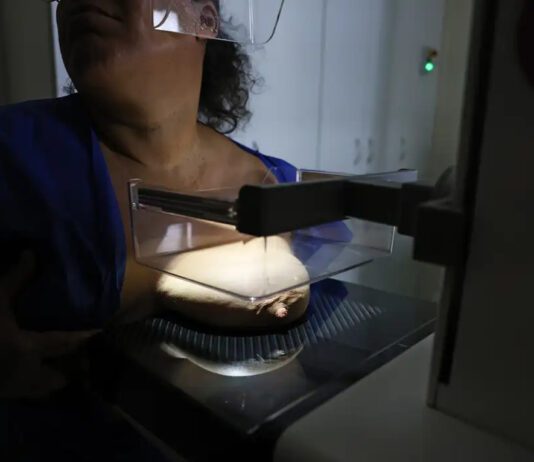 Câncer de mama em jovens: Prevenção deve começar cedo câncer de mama