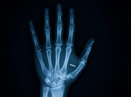 IMPLANTES: Evidências de tecnologia alienígena? IMPLANTES