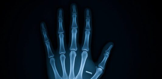 IMPLANTES: Evidências de tecnologia alienígena? IMPLANTES